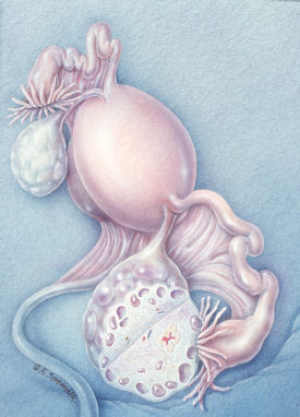 Illustration of polycystic ovary syndrome Illustration from Phototake Copyright  Kevin A Somerville