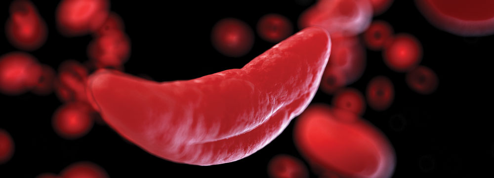 Primary care physicians should know that sickle cell patients might have pain after treatment due to preexisting joint damage or chronic pain linked to years of living with the disease Image by Sebas
