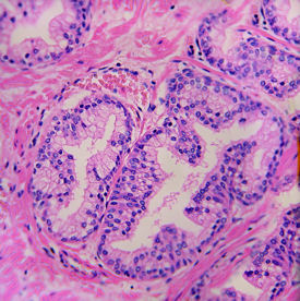 A high-power microscopic view of the glandular portion of the prostate gland