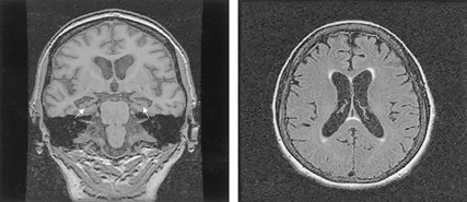 In this MKSAP image an MRI scan shows bilateral hippocampal atrophy arrows a typical feature of Alzheimers disease as well as mild diffuse cortical atrophy
