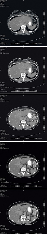 Computed tomography scan of the abdomen with oral and intravenous contrast revealed multiple target lesions worrisome for metastatic disease Images courtesy of Carlos I Smith ACP Member