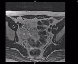 MRI image of a right ovarian mass measuring 32 times 32 times 39 cm