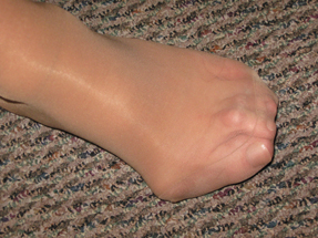 A classic sign of acromegaly is very large feet with thickened heel pads Other symptoms were overlooked by this patients doctors and co-workers including medical staff at the nursing home where she