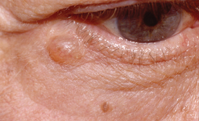 This patient has basal cell carcinoma the most common type of cutaneous malignancy It typically appears on the head and neck of older persons Sun exposure is the major risk factor Photo  Ame