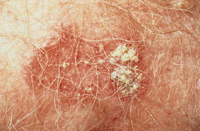 This patient has a squamous cell carcinoma SCC Immunosuppressive agents used to prevent allograft rejection increase the risk of malignancy Photo  American College of Physicians Medical Know