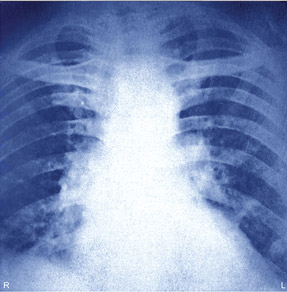 Pulmonary embolism by bilateral thrombuses thoracic X-ray Photo by BSIP slash Science Source