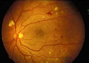 Dot-and-blot hemorrhages and clusters of hard yellowish exudates characteristic of nonproliferative diabetic retinopathy Photo c American College of Physicians