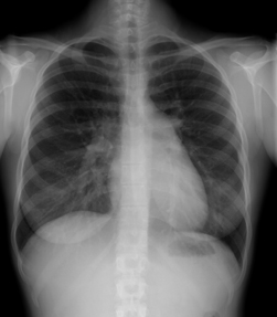 Chest radiograph showing right ventricular hypertrophy in a patient with pulmonary hypertension Photo c American College of Physicians
