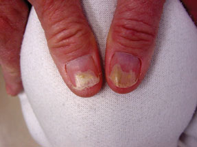 Psoriasis symptoms can flare anywhere in the body including the fingernails Note in this image from MKSAP 15 the prominent onycholysis separation of nail plate from nail bed Photo c American Col