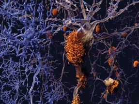 Shown are neurons with amyloid plaques Researchers are studying amyloid-positive cognitively normal people who are being treated with an antiamyloid antibody to see if it can slow the memory loss as