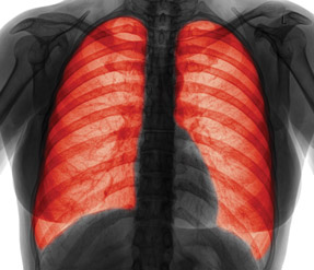 A single study, the FLAME trial, changed clinical practice for chronic obstructive pulmonary disease