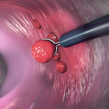 One benefit of screening colonoscopy as compared to stool-based testing for colorectal cancer is that it allows for the removal of precancerous polyps Image by Christoph Burgstedt
